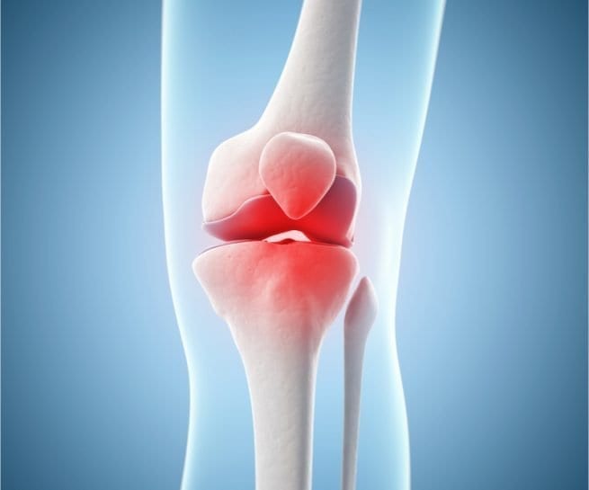 knee replacement surgery