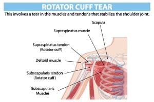 this is an image showing how the rotator cuff tear occurs in the muscles and tendons that stabilize the shoulder joint
